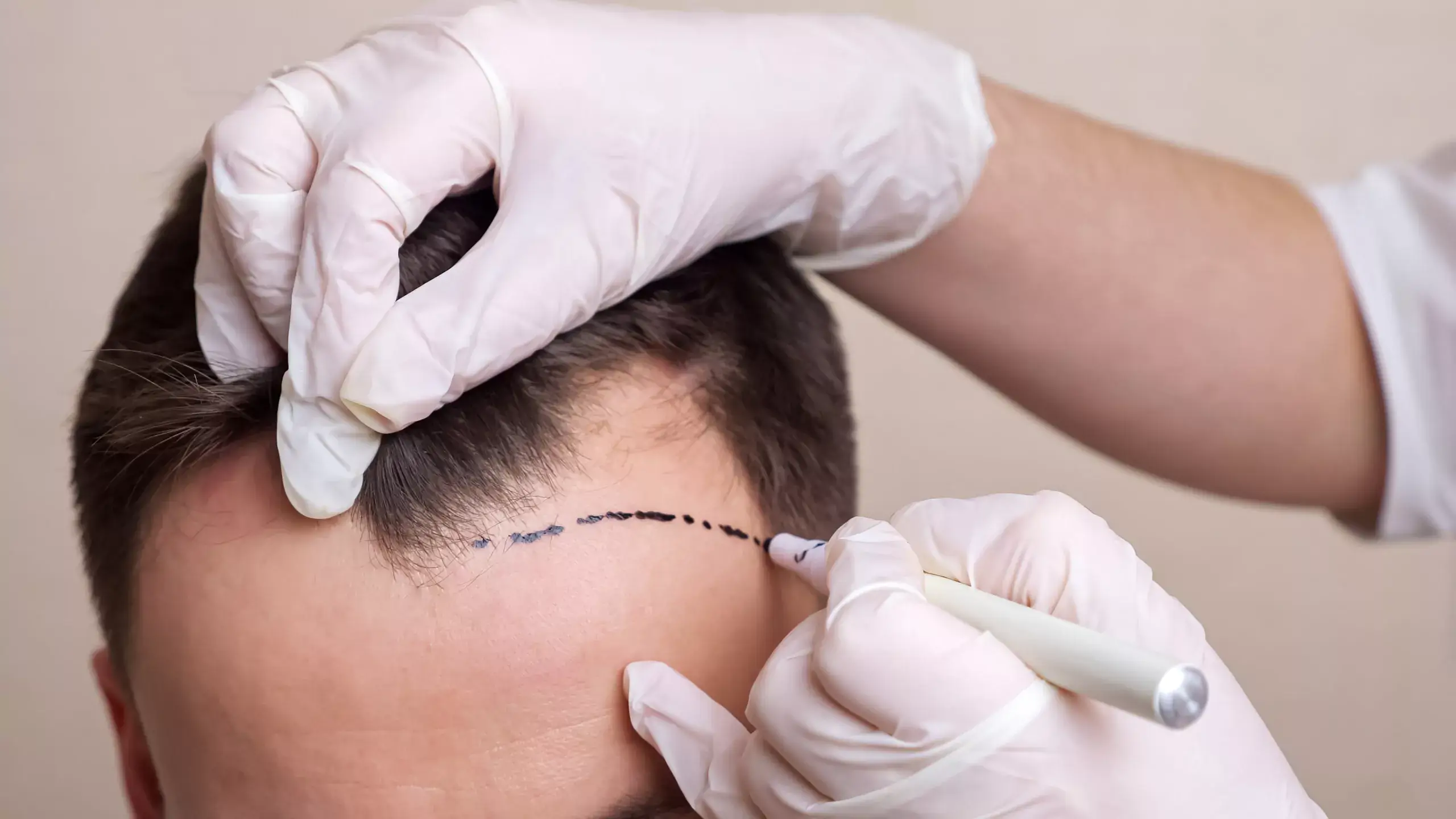 Greffe Capillaire Femme qui effectue un tatouage