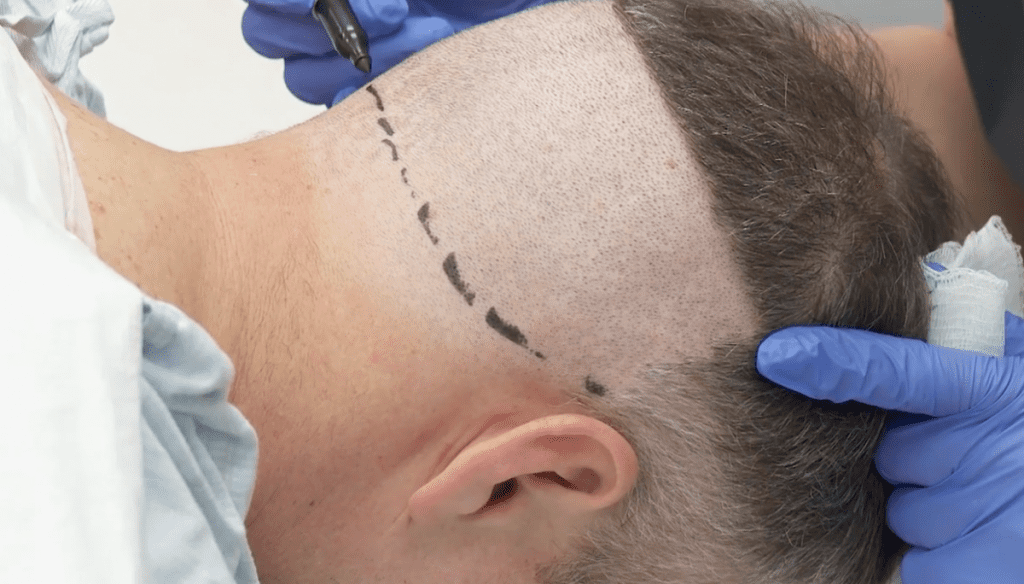 procedure-traitement-greffe-capillaire
